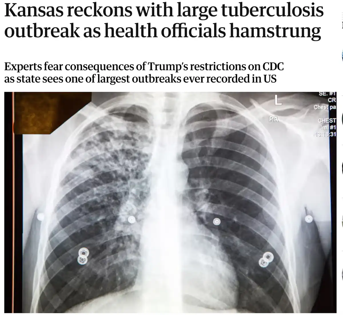 A chest X-ray image showing lungs with visible abnormalities, overlaid with news headlines about a tuberculosis outbreak in…