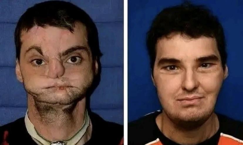 Two side-by-side mugshot-style photos of the same man: the left shows him with severe facial scarring and disfigurement…
