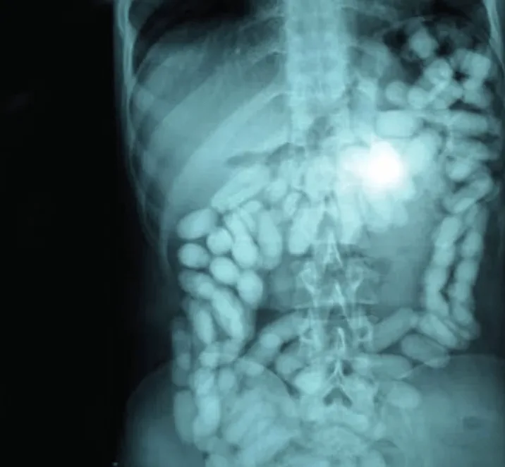 An x-ray image of a human torso showing the spine, ribs, and intestines filled with numerous bright, pill-shaped objects…