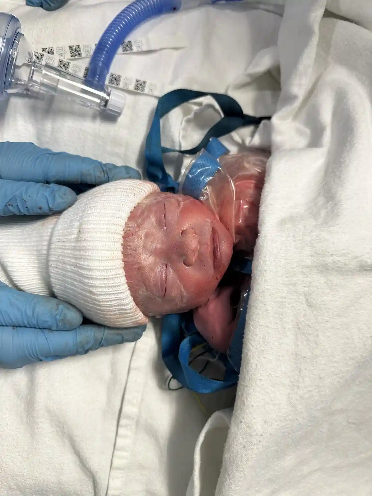 A newborn baby, wrapped in a white blanket and wearing a white knit cap, lies in a hospital bed with medical equipment…