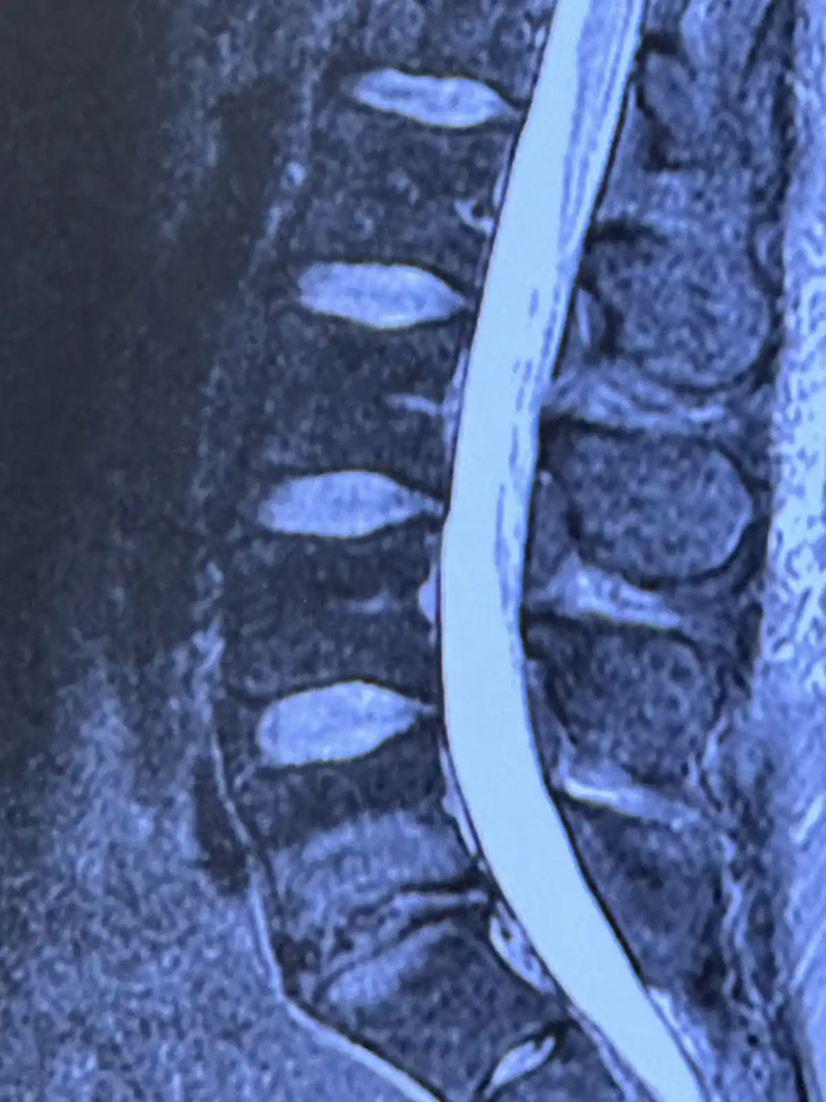 The Struggles of Lower Back Pain