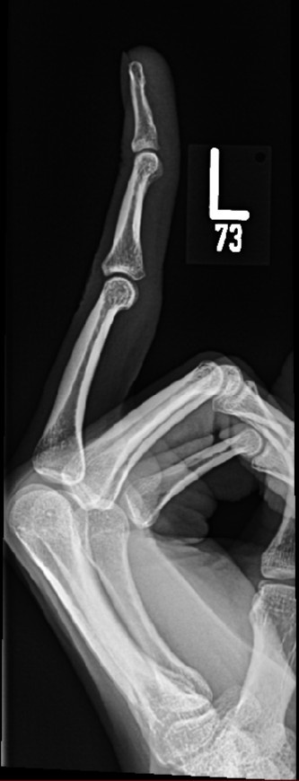 An x-ray image shows a human hand with the index finger extended upward, revealing its bones. In the upper right corner, a…
