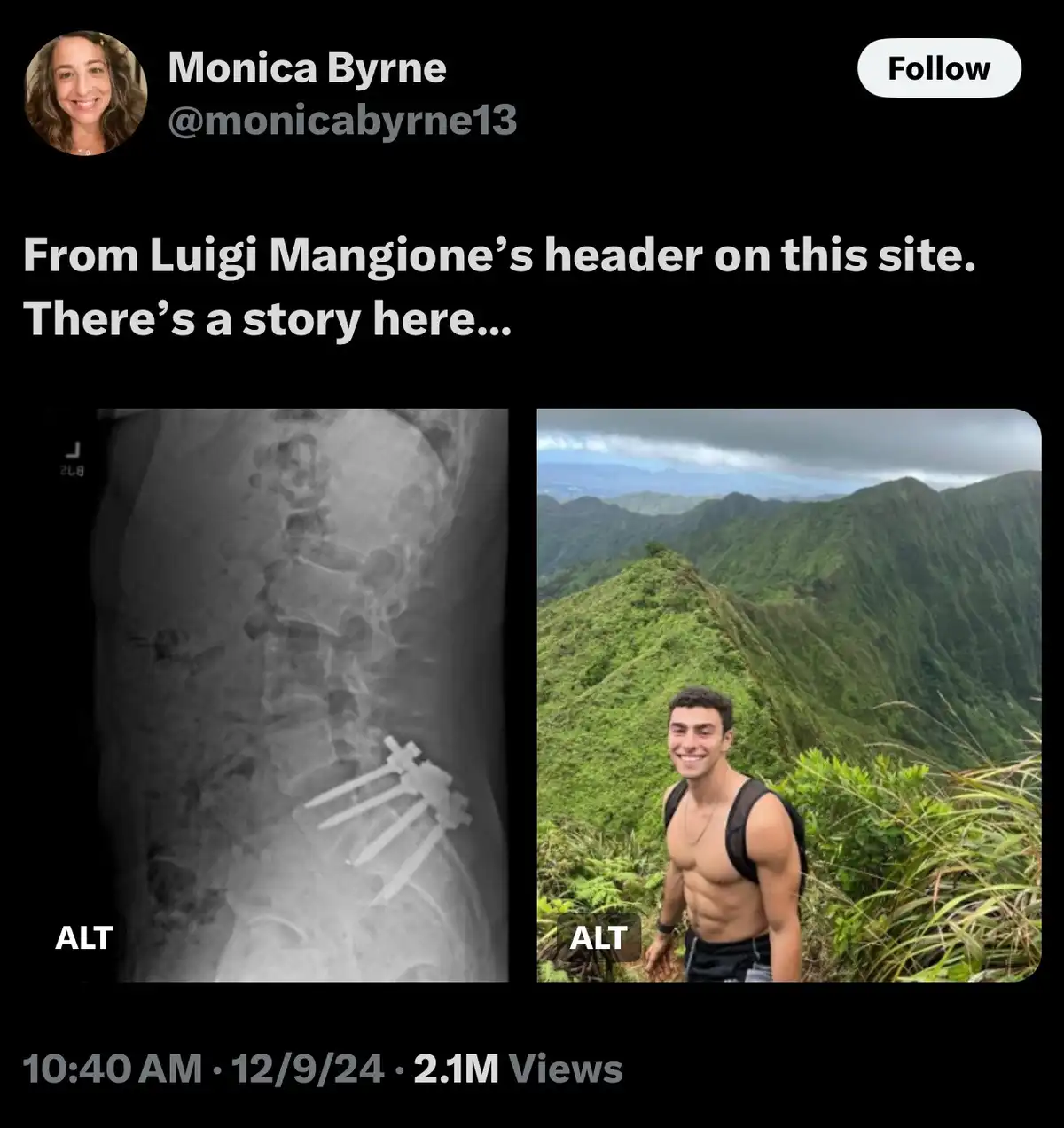 The image displays a side-by-side comparison: on the left, an x-ray showing a spine with multiple surgical rods and screws…