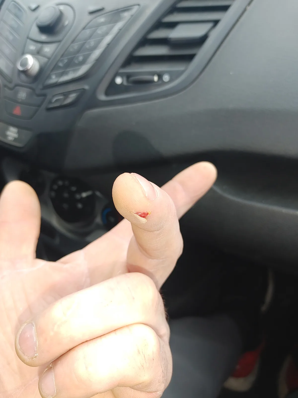 A close-up photo shows a person's hand inside a car, with the thumb prominently displayed and a small, fresh cut with blood…