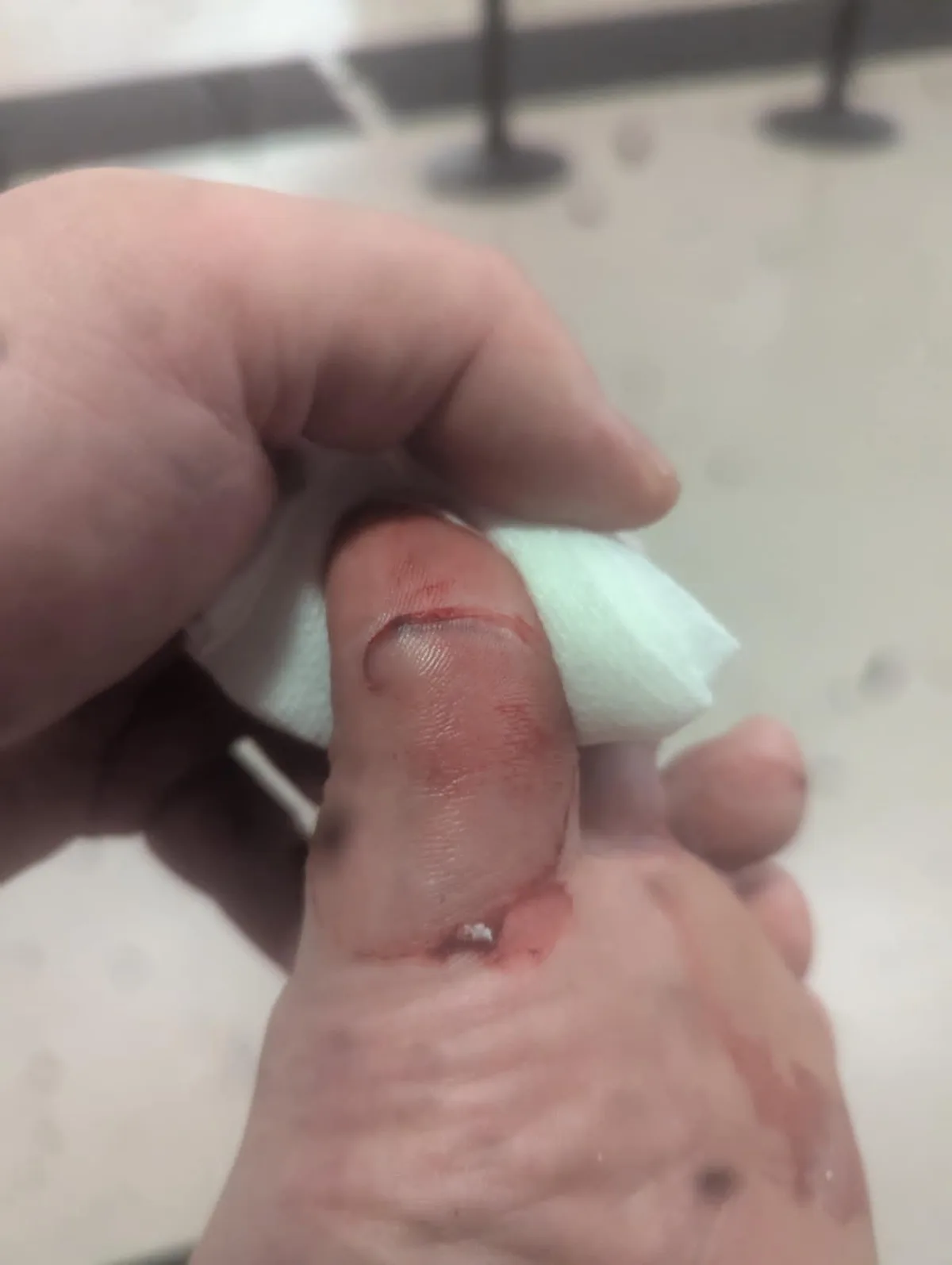 A close-up photo shows a person's foot with a visibly severed toe, wrapped in a white gauze pad, and blood on the skin. The…