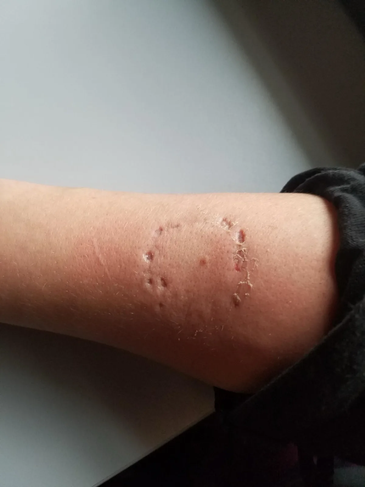 A close-up photo shows a person's forearm with multiple red, irritated, and some scabbed bite marks, likely from an insect…