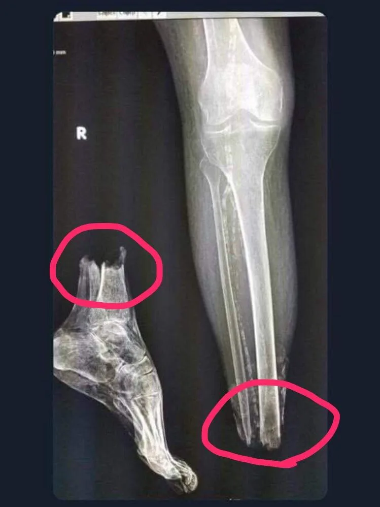This is a medical x-ray image of a right foot and lower leg, marked with a capital 'R' indicating the right side. Two areas…