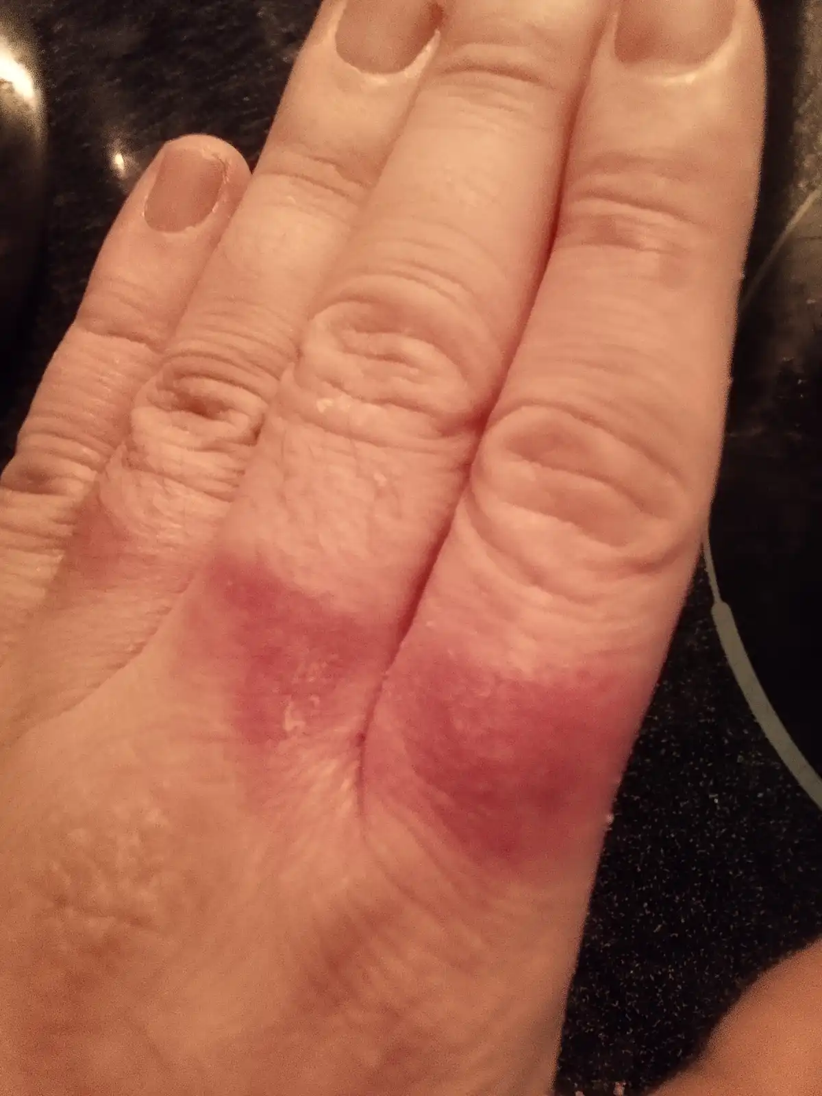 A close-up photo shows a person's hand with noticeable redness and swelling on the palm and fingers, likely from a burn or…