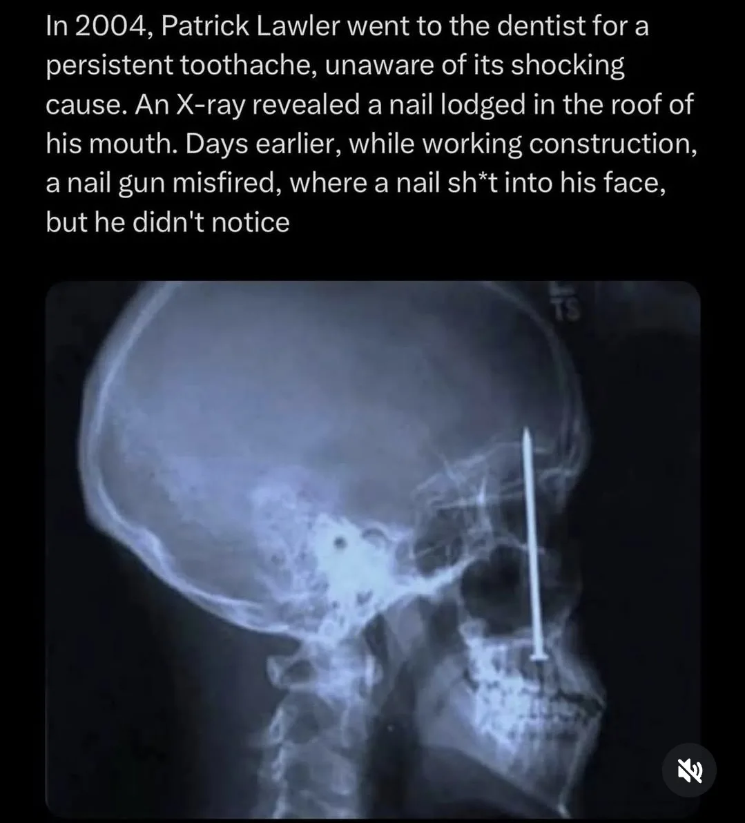 An x-ray image shows a long, straight metal object, resembling a nail, embedded vertically through the upper jaw and skull…
