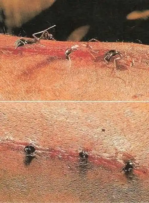 In some cultures, ants were ingeniously used to stitch wounds by biting down and holding the skin together while their bodies were removed, leaving only their heads behind.