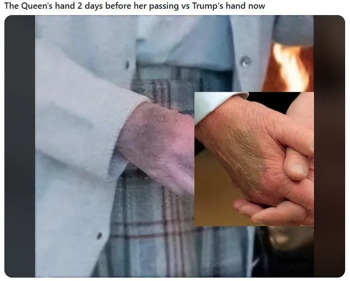 The image displays two side-by-side photos of elderly hands. The left photo shows a hand with visible purple bruising and…