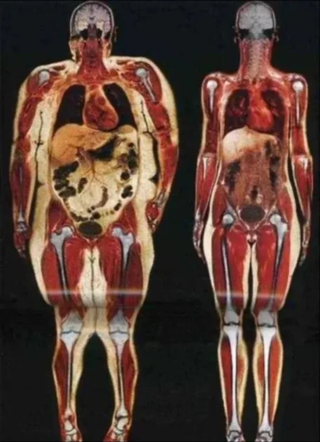 A striking comparison of visceral fat: 250lb vs 125lb women