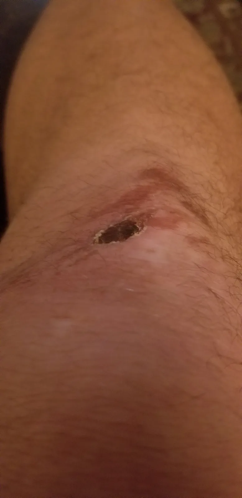 A close-up photo shows a small, raw, circular wound on a hairy leg, surrounded by red irritated skin. The overlaid text…