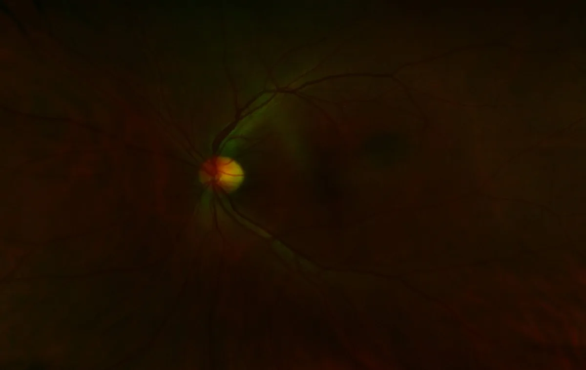 A dark, medical fundus photograph of a human eye showing the optic disc and branching retinal blood vessels, with a faint…