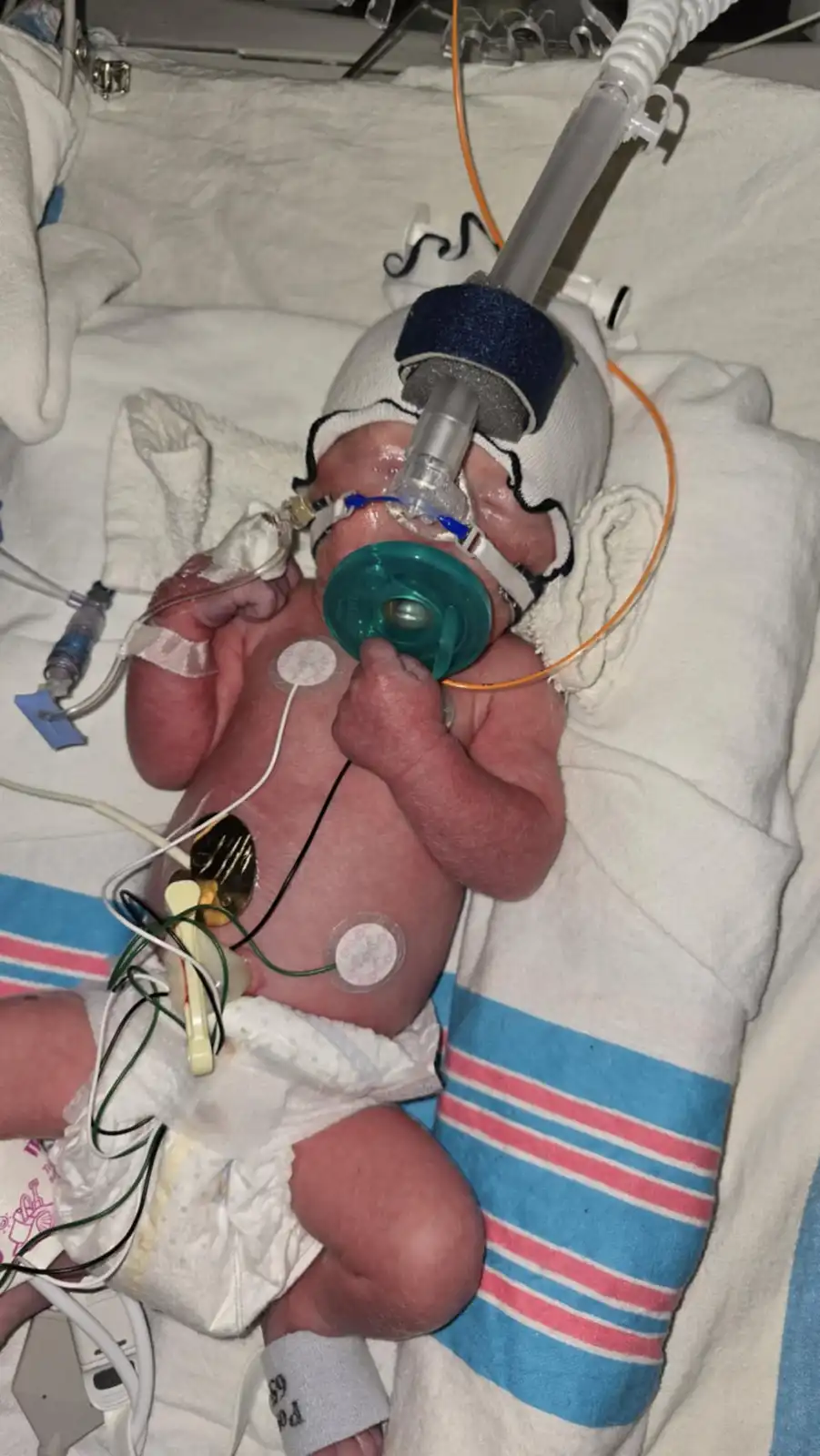A newborn baby in a hospital bed is connected to medical equipment, including a breathing tube and heart monitors, while…