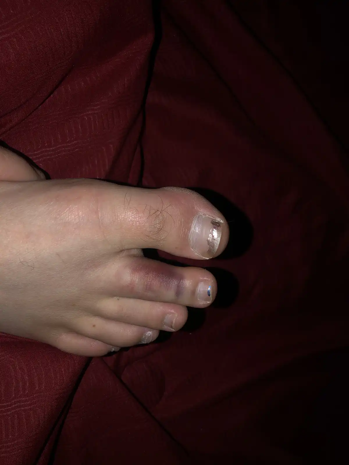 A close-up photo shows a person's foot resting on a dark red fabric, with the big toe displaying a noticeable bruise and a…