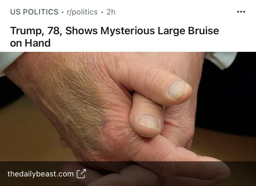 A close-up photo shows an elderly man's hand with a large, dark bruise on the back of the hand near the wrist, while his…