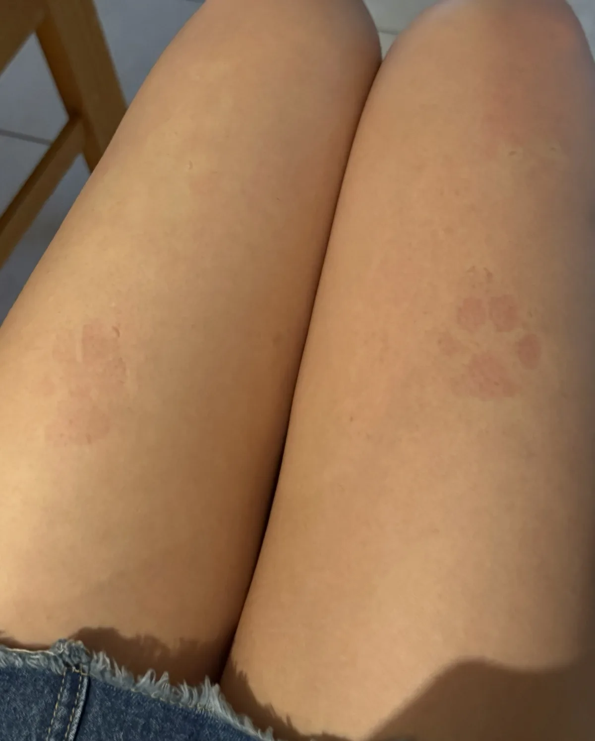 A close-up photo shows a person's bare legs, each with a distinct reddish-pink paw print-shaped mark, likely from a pet. The…