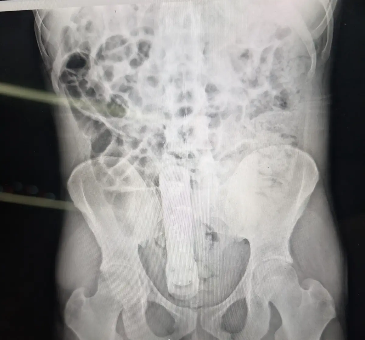 Wishing you a Happy New Year from our hospital! And don't forget to check that your device has a flange.