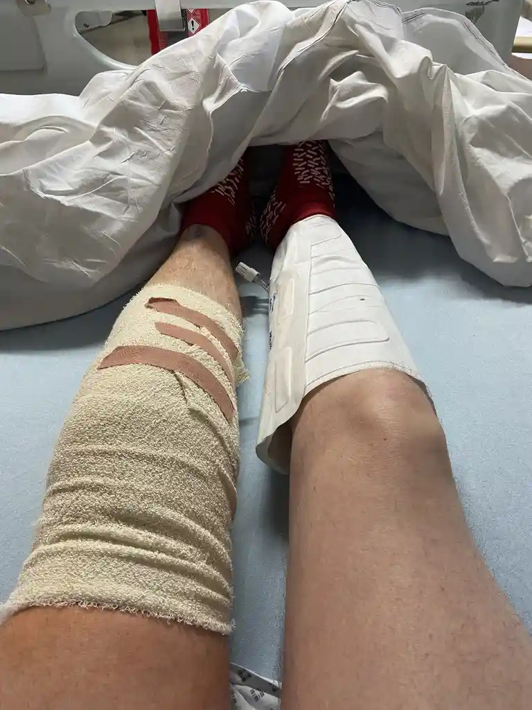 A person is lying in a hospital bed with one leg wrapped in beige gauze bandages featuring three brown stripes, and the…