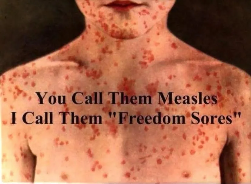 A person's upper torso and neck are covered in red measles-like spots. Overlaid text reads: 'You Call Them Measles I Call…
