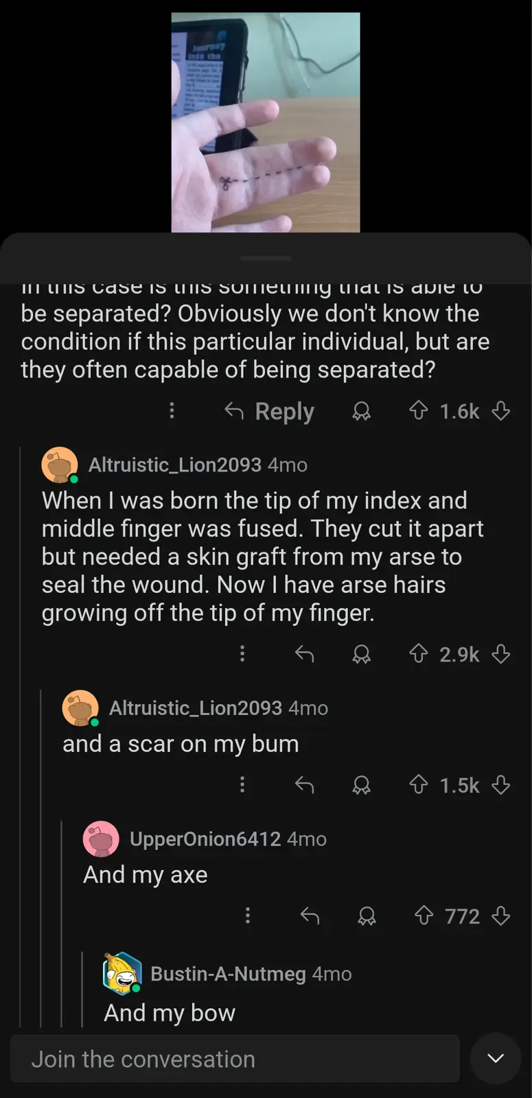 A screenshot of a Reddit comment thread where a user describes being born with fused index and middle fingers, requiring a…