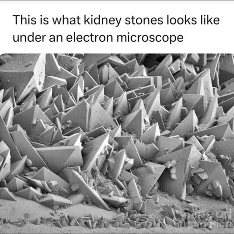 The Struggles of Kidney Stones...