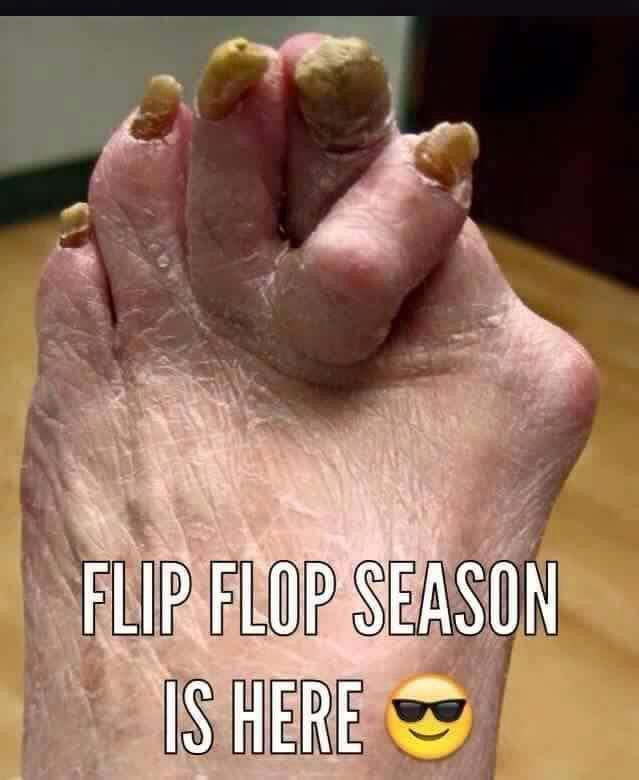 A close-up photo of a person's foot with severely damaged, thickened, and discolored toenails, likely due to fungal…
