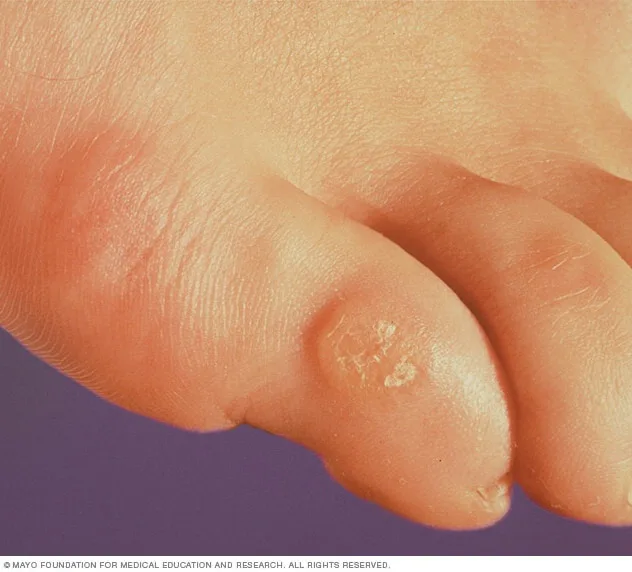 a close-up photo of a human toe with visible dry, flaky, and cracked skin on the top surface, set against a purple…