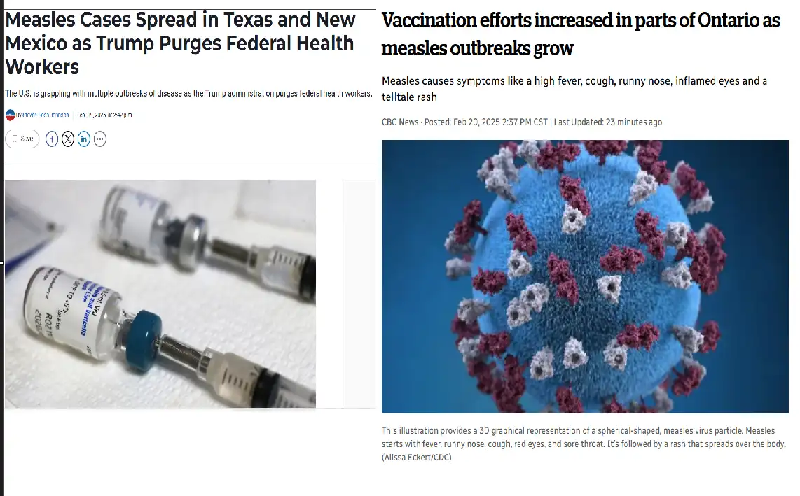 The image displays two side-by-side news articles about measles outbreaks. The left article, from Street Press, shows a…
